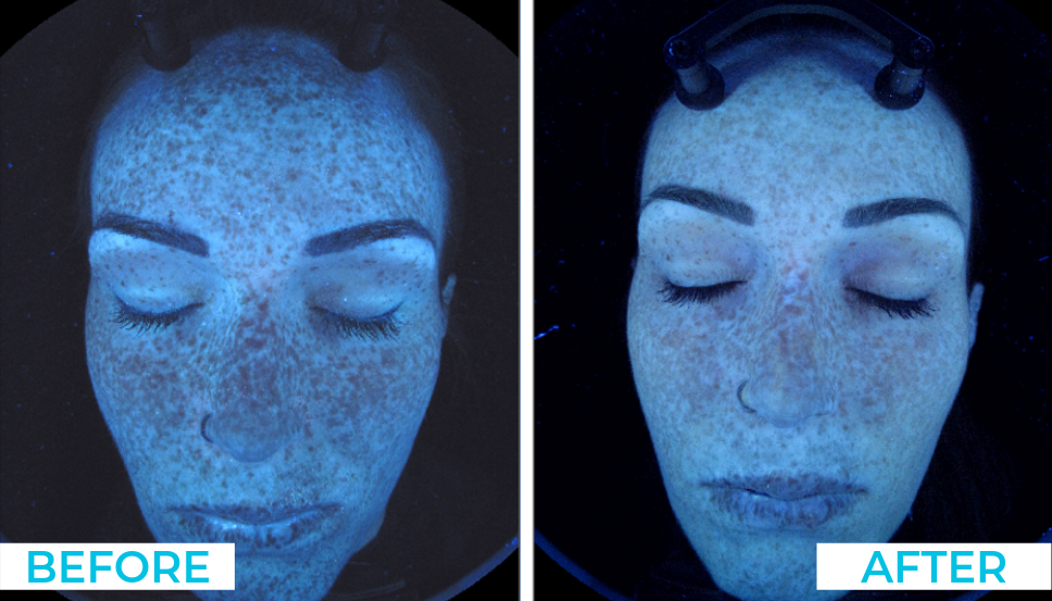 Skin Needling 2
